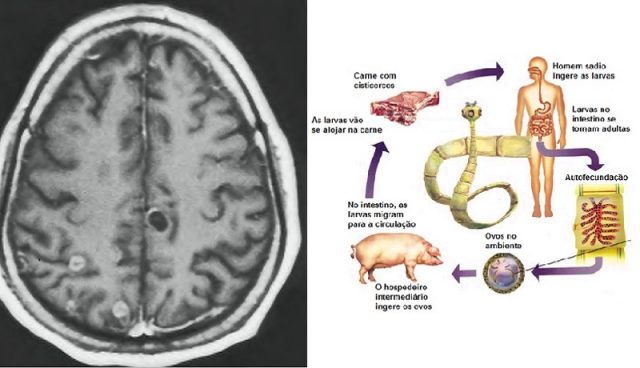 Neurocisticercose-cerebro-1-640x368 Veja porque os muçulmanos não comem carne de porco