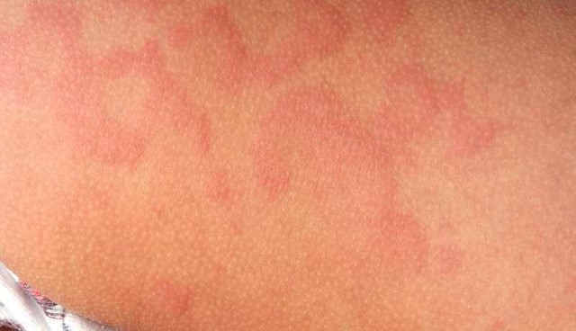 alergia-de-pele As 10 doenças mais comuns do mundo